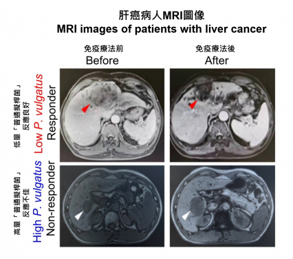 HKUMed researchers discovered that transplanting the gut bacterium Phocaeicola vulgatus into mouse models of liver cancer induced immunotherapy resistance. The finding in mice is consistent with clinical observations in patients, as illustrated by the representative MRI scans, showing that patients with low levels of Phocaeicola vulgatus responded better to treatment.